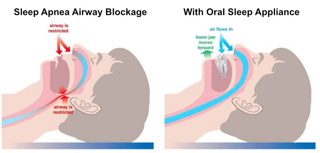 Best Sleep Apnea Mouthpieces Stuart Florida 1 Oral Sleep Appliance